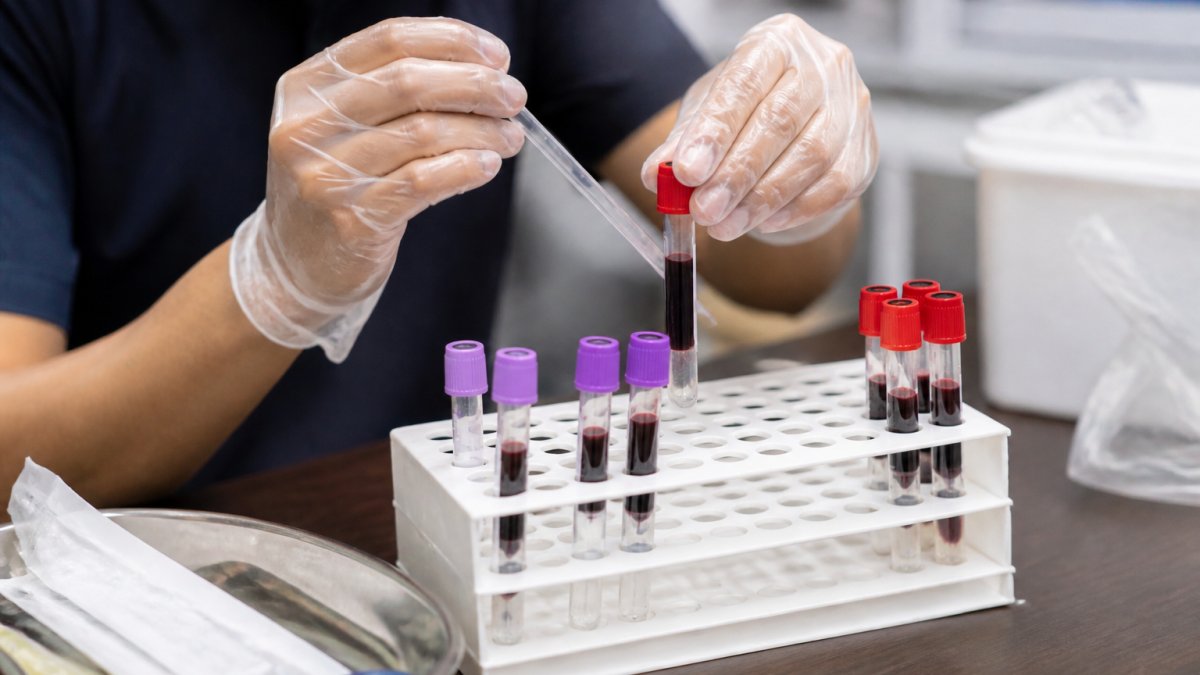 DUTCH Testing vs. Blood Hormone Testing: Which Reveals More